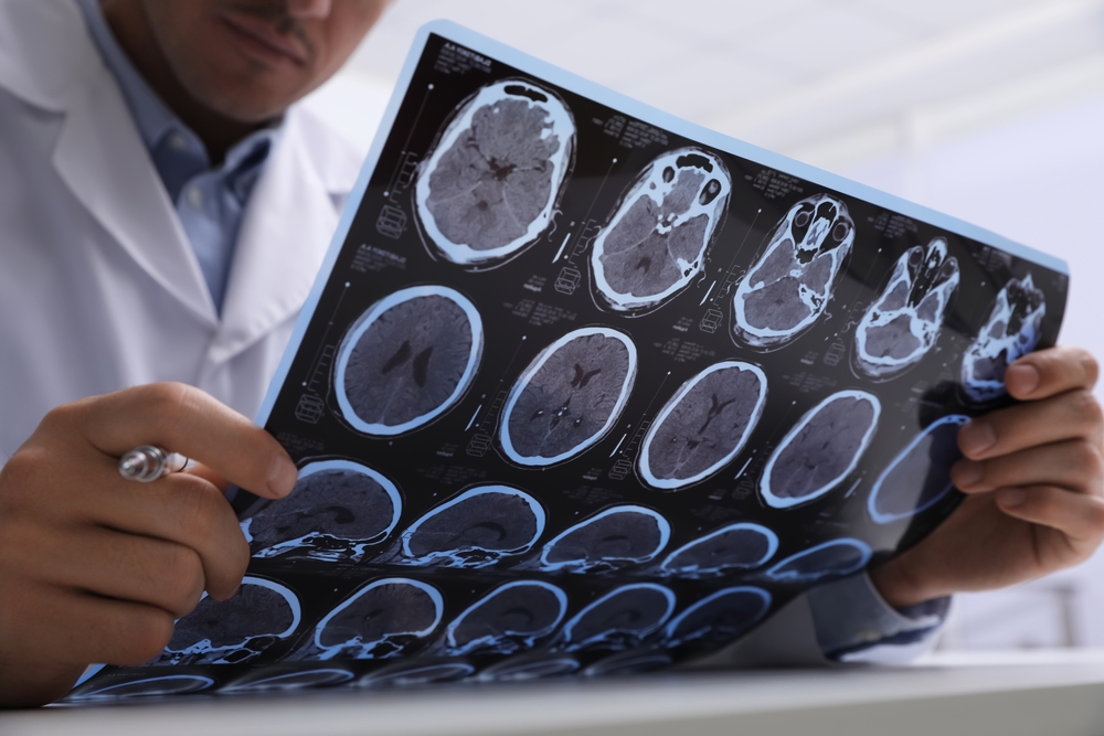 Brain Injuries